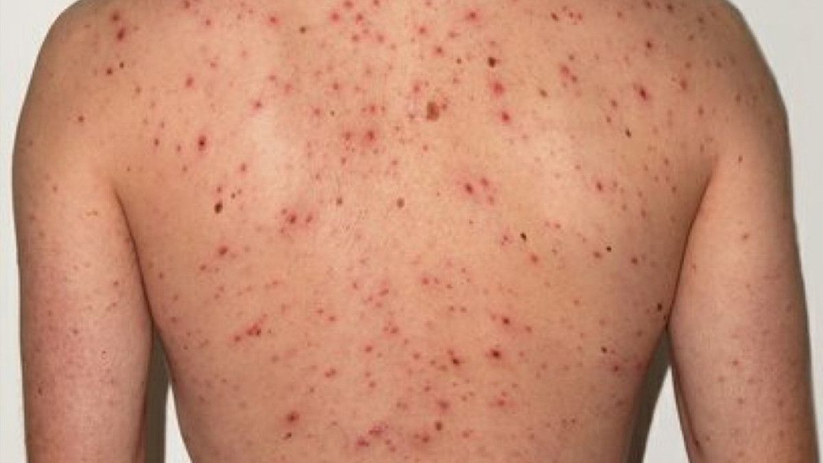 दादुराका ६७ बिरामी उपचारपछि घर फर्के, २० जनाको ‘आइसोलेसन’ उपचार जारी