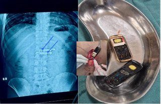 कैदीको पेटबाट निकालियो मोबाइल, एक वर्षअघि निलेका थिए