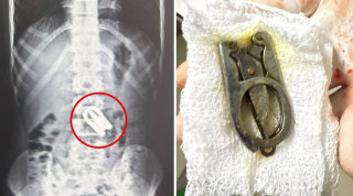 बालकको पेटमा अड्किएको कैंची शल्यक्रियाबाट निकालियो