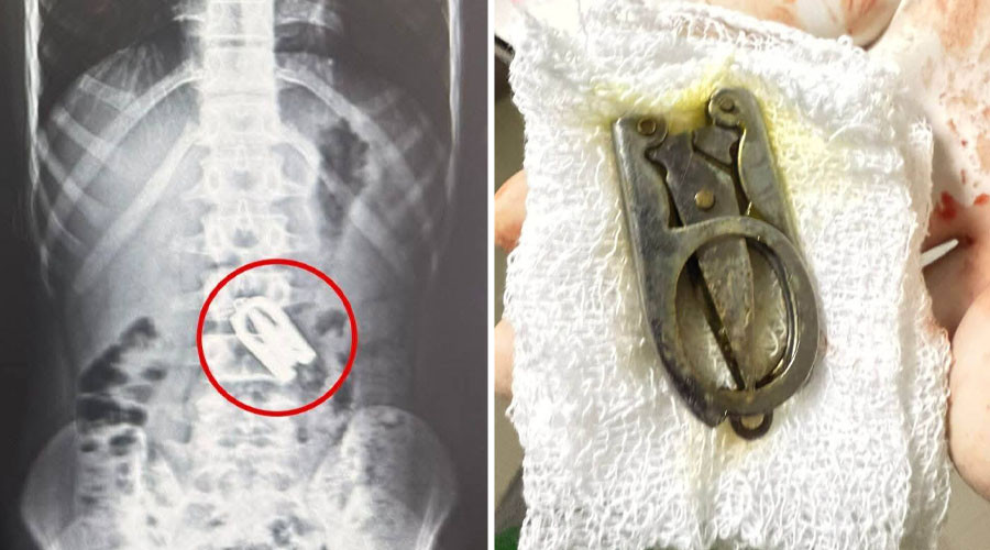 बालकको पेटमा अड्किएको कैंची शल्यक्रियाबाट निकालियो