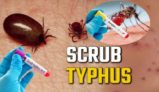 सङ्खुवासभामा स्क्रब टाइफस र डेङ्गु सङ्क्रमितका सङ्ख्यामा वृद्धि