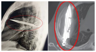 ८ वर्षसम्म पुरुषको छातीमा अड्कियो  चक्कुको ब्लेड, एक्स–रे परीक्षणमा देखियो यस्तो