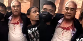 देउवाको घाँटीमा लगाइएका टाँका आजको चार दिनपछि काटिने, कहिले डिस्चार्ज गर्ने भन्ने निश्चित छैन्