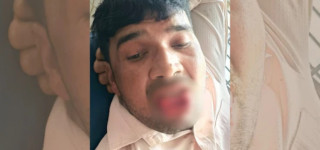 एक पुरुषले  बालिकालाई जबरजस्ती चुम्बन गर्दा टोकेर चुडाई दिन जिब्रो