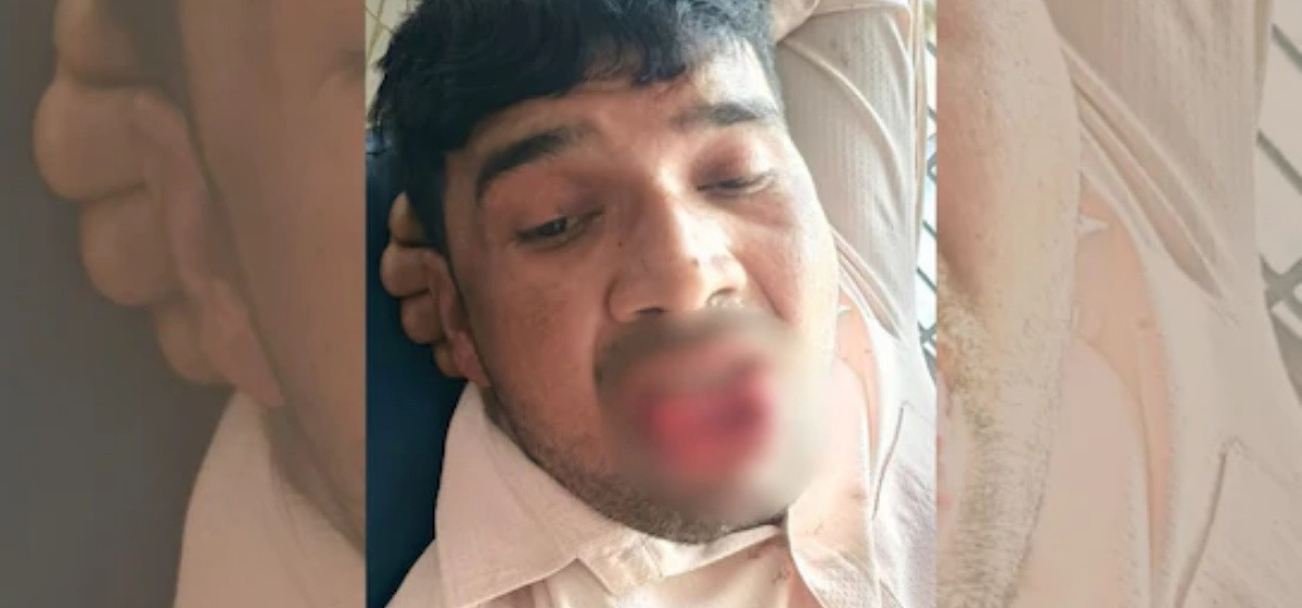 एक पुरुषले  बालिकालाई जबरजस्ती चुम्बन गर्दा टोकेर चुडाई दिन जिब्रो