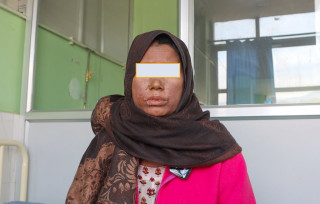 दुर्लभ रोग सामान्यीकृत पस्टुलर सोरायसिस भएकी महिलाको नेपाल मेडिकल कलेजमा सफल उपचार