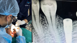 लुम्बिनी प्रादेशिक अस्पतालमा पहिलोपटक दाँतको प्रत्यारोपण