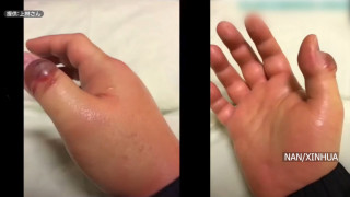 जापानमा एक हजार नाघे स्ट्रेप्टोकोकल टक्सिक शक सिन्ड्रोम केस