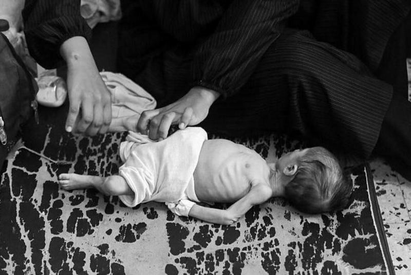 गाजामा कुपोषणका कारण थप ११ जनाको मृत्यु