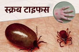 स्क्रबटाइफसबाट एक बालिकाको मृत्यु